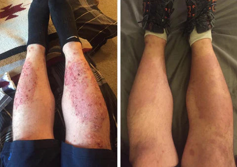 Nuevo spray natural para la piel: elimina la psoriasis y dermatitis desde la primera semana