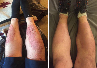 Nuevo spray natural para la piel: elimina la psoriasis y dermatitis desde la primera semana